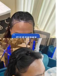 -碧莲盛·不剃发植发
