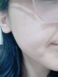 体验后-正璞医疗美容·皮肤修复·微整注射