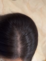 -碧莲盛·不剃发植发