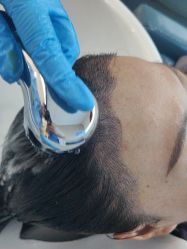 体验后-大麦微针植发全国连锁