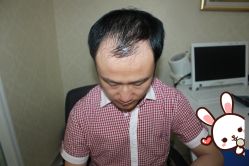 -大麦微针植发丨全国连锁