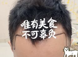 -大麦微针植发全国连锁