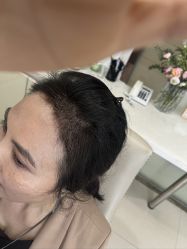 -大麦微针植发丨全国连锁