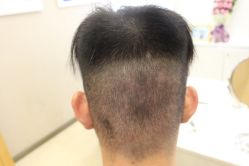 -大麦微针植发丨全国连锁