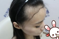 点击看大图 -大麦微针植发丨全国连锁