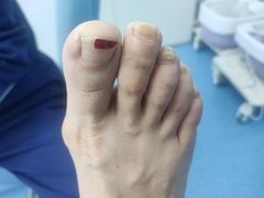 -Andrew指甲专科灰指甲·甲沟炎矫正·3D步态矫形鞋垫定制(上海法华镇路旗舰店)