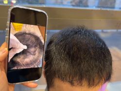 -碧莲盛·不剃发植发