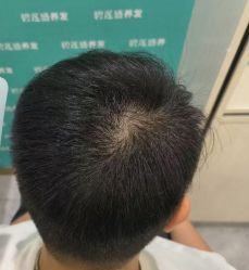 -碧莲盛·不剃发植发