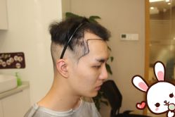 点击看大图 -大麦微针植发丨全国连锁