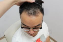 -大麦微针植发丨全国连锁