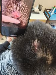 -碧莲盛·不剃发植发