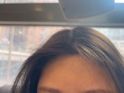 -碧莲盛·不剃发植发