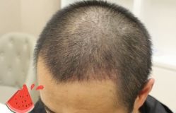 -大麦微针植发丨全国连锁