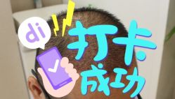 -大麦微针植发全国连锁