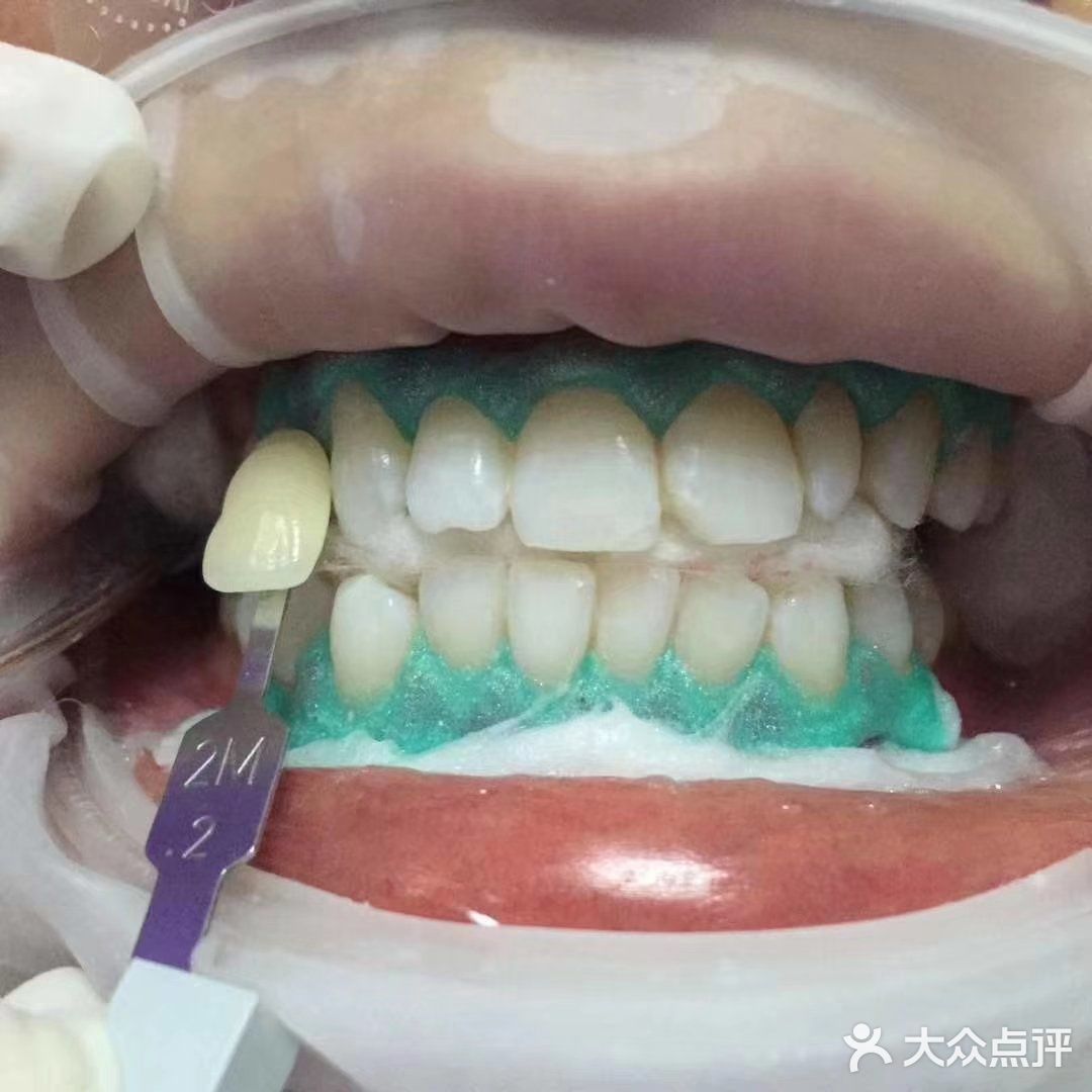 定期洁牙给你带来的意外和惊喜