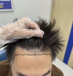 -大麦微针植发全国连锁