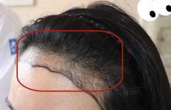 -大麦微针植发全国连锁