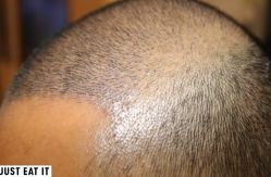 -大麦微针植发丨全国连锁