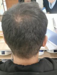 -碧莲盛·不剃发植发