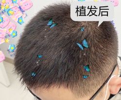 -大麦微针植发全国连锁