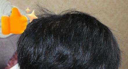 -大麦微针植发丨全国连锁