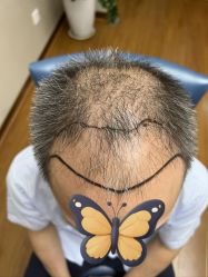 点击看大图 体验前-大麦微针植发全国连锁