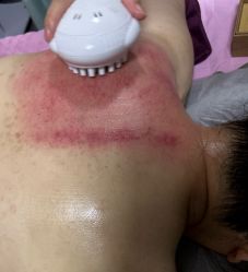 -苗塑堂减肥艾灸