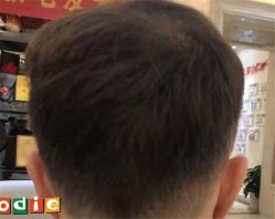 -大麦微针植发全国连锁