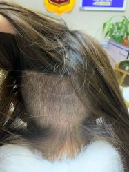 -大麦微针植发全国连锁