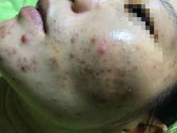 -苗医生草本科技祛痘