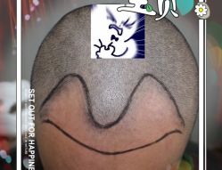 -大麦微针植发全国连锁