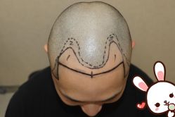 点击看大图 -大麦微针植发丨全国连锁