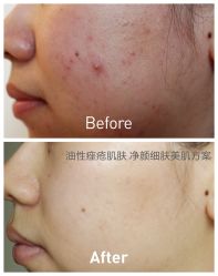 光SPA水氧opt-光SPA科技美肤