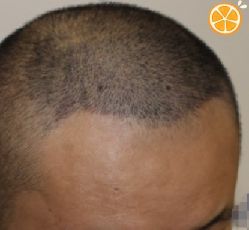 -大麦微针植发丨全国连锁