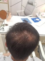 点击看大图 -碧莲盛·不剃发植发