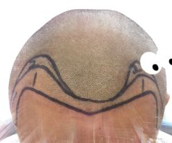 -大麦微针植发全国连锁