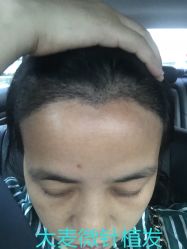 点击看大图 -大麦微针植发丨全国连锁