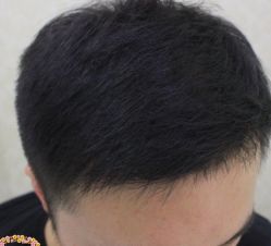 -大麦微针植发丨全国连锁