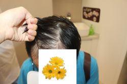 -大麦微针植发丨全国连锁