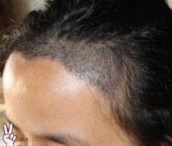 -大麦微针植发丨全国连锁