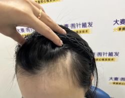 -大麦微针植发全国连锁