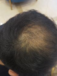 -碧莲盛·不剃发植发