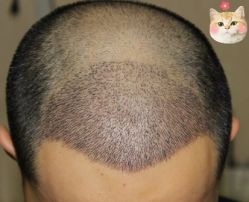 -大麦微针植发丨全国连锁