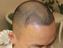 -大麦微针植发丨全国连锁