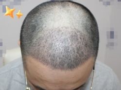 -大麦微针植发丨全国连锁