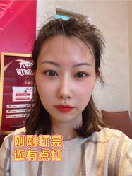 点击看大图 体验后-天津时光诺颜·轻医美·轮廓抗衰中心