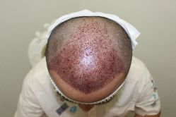 点击看大图 -大麦微针植发丨全国连锁