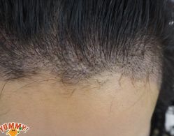 -大麦微针植发丨全国连锁