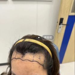 -大麦微针植发全国连锁