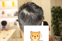 -大麦微针植发丨全国连锁